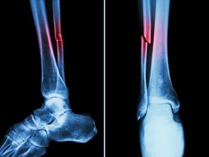 درد استخوان جلوی ساق پا+ علت تیر کشیدن استخوان پا